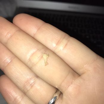 Shelbourne & Associates - Bone shard I pulled out of my gums 2 months after wisdom teeth surgery. - Oral Surgeons Near Me - Mount Pleasant, South Carolina