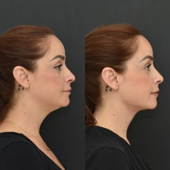 Brandyn Dunn MD - In-office Chin Lipo - Plastic Surgeons Near Me - Newport Beach, California Brandyn Dunn MD - In-office Chin Lipo - Plastic Surgeons Near Me - Newport Beach, California