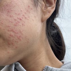 Brow Spa - 2 days after getting cheeks threaded