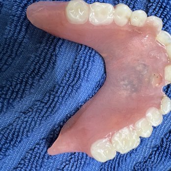 Affordable Dentures & Implants - Poorly made denture made by Dr. Boone - General Dentistry Near Me - Flowood, Mississippi Affordable Dentures & Implants - Poorly made denture made by Dr. Boone - General Dentistry Near Me - Flowood, Mississippi