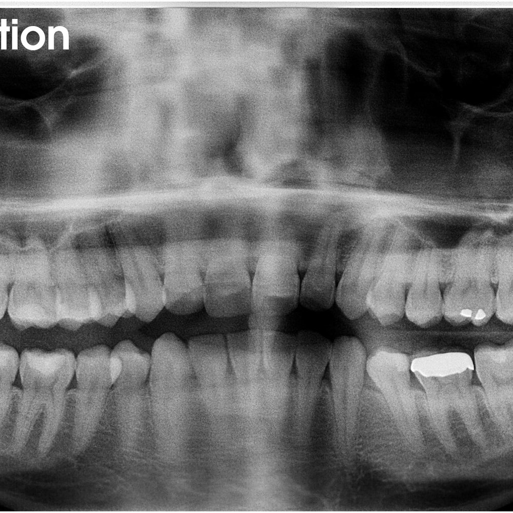Sharad Sohoni, DDS - Panoramic x-ray post wisdom teeth extraction. All teeth out - no nerve damage done! - Oral Surgeons Near Me - Mountain View, California Sharad Sohoni, DDS - Panoramic x-ray post wisdom teeth extraction. All teeth out - no nerve damage done! - Oral Surgeons Near Me - Mountain View, California