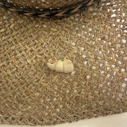 Cancún Cosmetic Dentistry - Crowns that fell out the day after we left Cancún