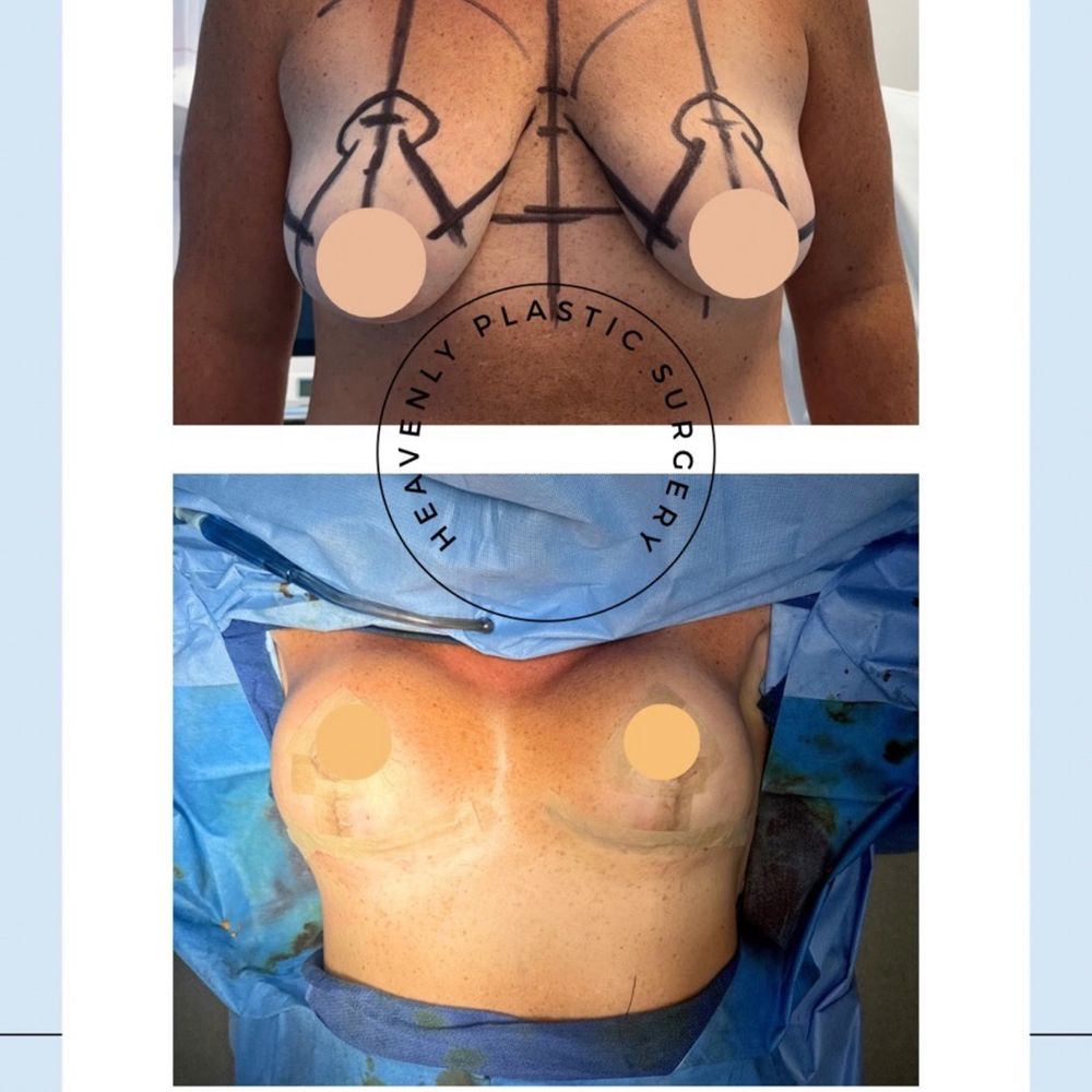 Heavenly Plastic Surgery - Before and after - absolute work of art done by this Dr! - Plastic Surgeons Near Me - Lake Forest, California Heavenly Plastic Surgery - Before and after - absolute work of art done by this Dr! - Plastic Surgeons Near Me - Lake Forest, California