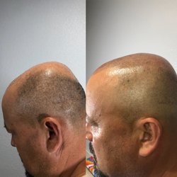 The Hideaway Salon Suites - Before and after treatments for hair loss and scar disguise by Ron