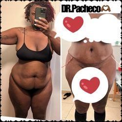 Professional Plastic Surgery - Two days post op