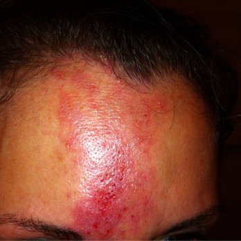 Trimcare - My forehead after Juvederm was injected between my eyes. - Medical Spas Near Me - Las Vegas, Nevada Trimcare - My forehead after Juvederm was injected between my eyes. - Medical Spas Near Me - Las Vegas, Nevada