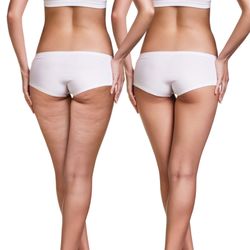 New U Rejuvenation Center - Endermologie Reduce cellulite-Smooth skin