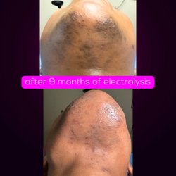 Neurospice Beauty - Mid-30s client with PCOS/PMOS