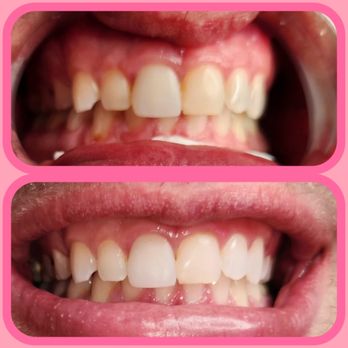 Bombshell Beauty - Teeth Whitening Near Me - Sacramento, California