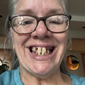 Smiles Dental - Sedro-Woolley - I had multiple abscesses, broken teeth, and pain. Everything tasted like a dead mouse. Brushing was a nightmare of pain and crumbling teeth - Cosmetic Dentists Near Me - Sedro-Woolley, Washington Smiles Dental - Sedro-Woolley - I had multiple abscesses, broken teeth, and pain. Everything tasted like a dead mouse. Brushing was a nightmare of pain and crumbling teeth - Cosmetic Dentists Near Me - Sedro-Woolley, Washington