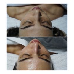 Ariani King Therapy and Beauty - Before and after dermaplane facial