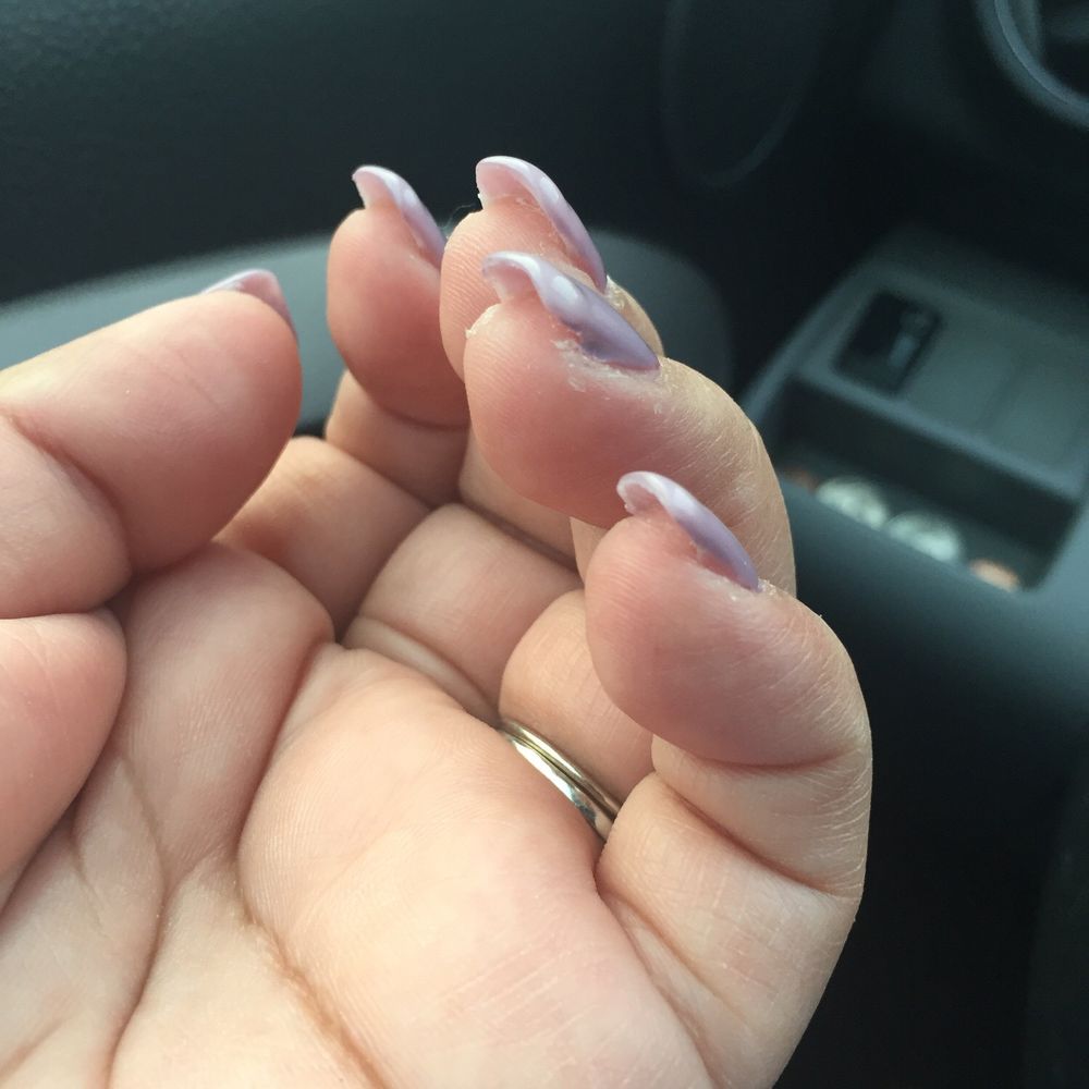 There is a very obvious lump on my ring finger nail. There is a very obvious lump on my ring finger nail.
