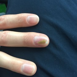 Davi Nails - Fungal nail infection from manicure at Davi Nails