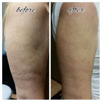 Soothe Aesthetics - Instant Lift Treatment can be done on almost any part of the body. End results here are toned arms with smoother texture. - Skin Care Near Me - Spring, Texas Soothe Aesthetics - Instant Lift Treatment can be done on almost any part of the body. End results here are toned arms with smoother texture. - Skin Care Near Me - Spring, Texas