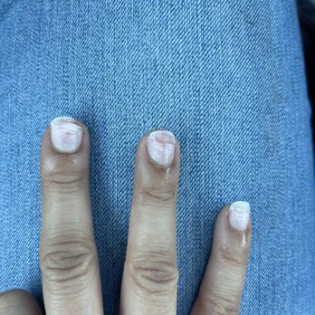 Blue Bliss Nails Spa - 1st Pic of the damage cause by lazy tech - Nail Salons Near Me - Chandler, Arizona