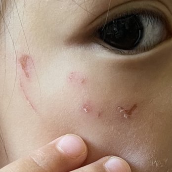 Bellevue Montessori School - Scratch by another kid near the eye - Elementary Schools Near Me - Bellevue, Washington