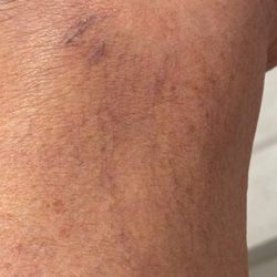 Apex Vein and Vascular Institute - Spider veins inside my left knee.