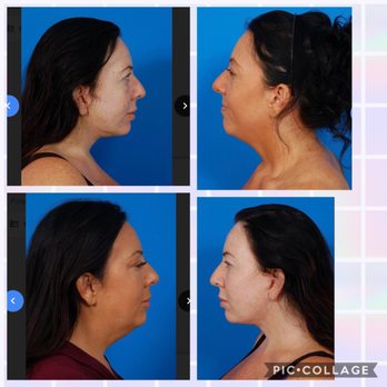 Sunset Cosmetic Surgery - Right bottom pic and top left are 1 week after surgery. - Cosmetic Surgeons Near Me - West Hollywood, California Sunset Cosmetic Surgery - Right bottom pic and top left are 1 week after surgery. - Cosmetic Surgeons Near Me - West Hollywood, California