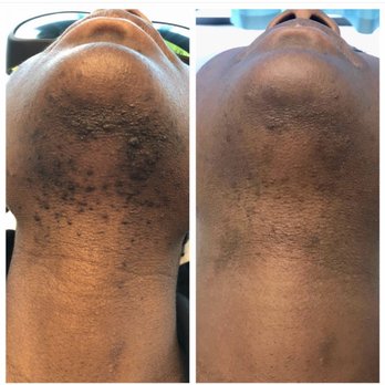 ChicMed Laser & Esthetic Center - It's even better than the second picture now !!! - Medical Spas Near Me - Waltham, Massachusetts