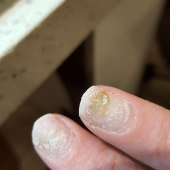 Madison Nails - NAIL FUNGUS!!! - Massage Near Me - Vancouver, Washington Madison Nails - NAIL FUNGUS!!! - Massage Near Me - Vancouver, Washington