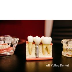 All Valley Dental - Dental Implants at All Valley Dental.