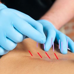 Monte Sano Acupuncture & Herbs - I had great results for help with my thyroid issues and took my son in for some sports injury back strain from football. It worked great!