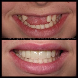 Chappaqua Smiles - Implants