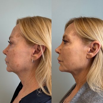 Ocean Aesthetics - Dermal Filler to chin, cheeks, jawline - Skin Care Near Me - Santa Monica, California Ocean Aesthetics - Dermal Filler to chin, cheeks, jawline - Skin Care Near Me - Santa Monica, California