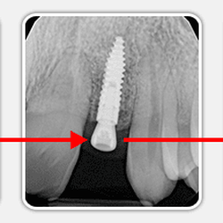 Santa Teresa Dental - Dental Implants