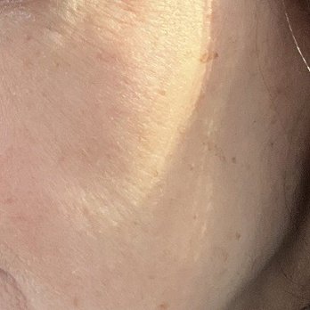 Face Forward Medical Aesthetics - Face before BBL. - Medical Spas Near Me - Lexington, Massachusetts Face Forward Medical Aesthetics - Face before BBL. - Medical Spas Near Me - Lexington, Massachusetts