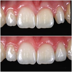 Wallingford Smiles - Veneer restoration of a congenital small size lateral incisor
