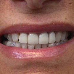 Marshall A Polan, DDS - Huntington Dentist - VENEERS AFTER