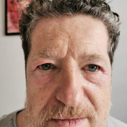 Royal Aesthetic Center - After the non surgical eye lif and bags