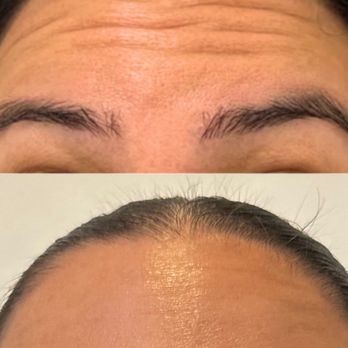 JT Aesthetic & Co - Jeuveau before + after - Aestheticians Near Me - South Pasadena, California JT Aesthetic & Co - Jeuveau before + after - Aestheticians Near Me - South Pasadena, California