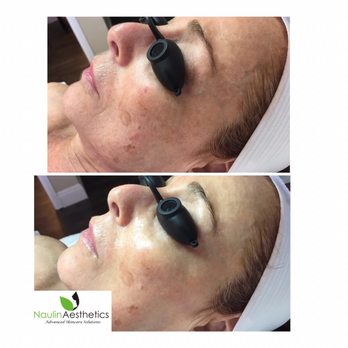 Naulin Aesthetics - Serum Infusion Facial. - Skin Care Near Me - Thousand Oaks, California Naulin Aesthetics - Serum Infusion Facial. - Skin Care Near Me - Thousand Oaks, California