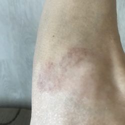 Jason P Garcia, MD, FAAOS - Photo of what K-Tape was doing to my knees