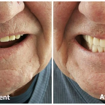 Kelowna Denture Clinic - Before - Dentures were 10+ years old, made after a full clearance of lower dentition.
After - New complete upper & lower dent... - Health & Medical Near Me - Kelowna, British Columbia Kelowna Denture Clinic - Before - Dentures were 10+ years old, made after a full clearance of lower dentition.
After - New complete upper & lower dent... - Health & Medical Near Me - Kelowna, British Columbia