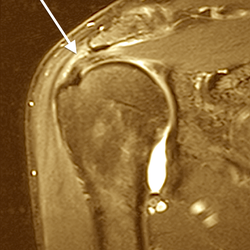 Noel Peterson ND, DAAPM - Oregon Regenerative Medicine - Evidence-based non-surgical repair of rotator cuff injuries