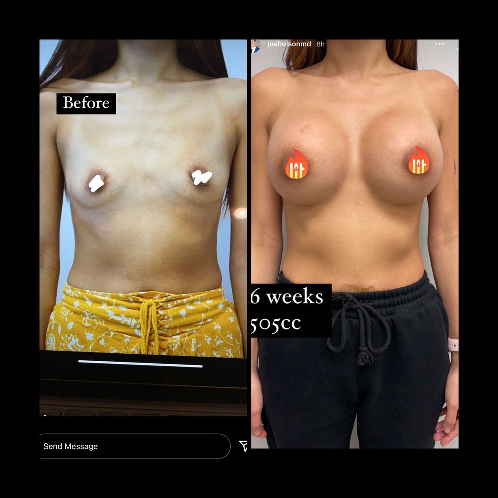 Advanced Plastic Surgery Institute - Before and after (6weeks) - Medical Spas Near Me - Gilbert, Arizona