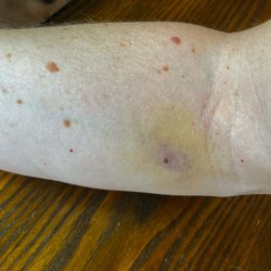 Quest Diagnostics - Bruising 5 days later