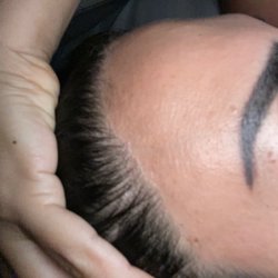 Biltmore Surgical Hair Restoration - Full temples