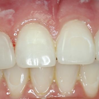 Christopher M Herman, DDS - Actual Patient After Photo - Cosmetic Dentists Near Me - Oceanside, California Christopher M Herman, DDS - Actual Patient After Photo - Cosmetic Dentists Near Me - Oceanside, California
