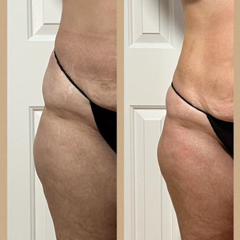BodySculpt305 - Body Contouring Near Me BodySculpt305 - Body Contouring Near Me