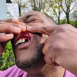 King Dental - You see where he cut my GUMS IN HALF!!!!!