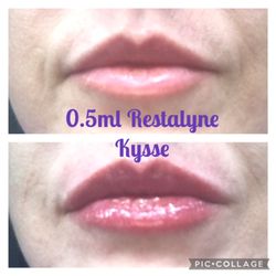 Practically Perfect Facial Aesthetics - Before and after lip filler