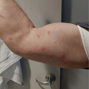 Whitney Peak Hotel Reno, Tapestry Collection by Hilton - Bed bug bites - Hotels Near Me - Reno, Nevada Whitney Peak Hotel Reno, Tapestry Collection by Hilton - Bed bug bites - Hotels Near Me - Reno, Nevada