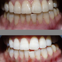 DaVinci Teeth Whitening Systems