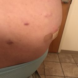 Sentara Albemarle Medical Center - Elizabeth City - Distended stomach NOT notated in medical charts