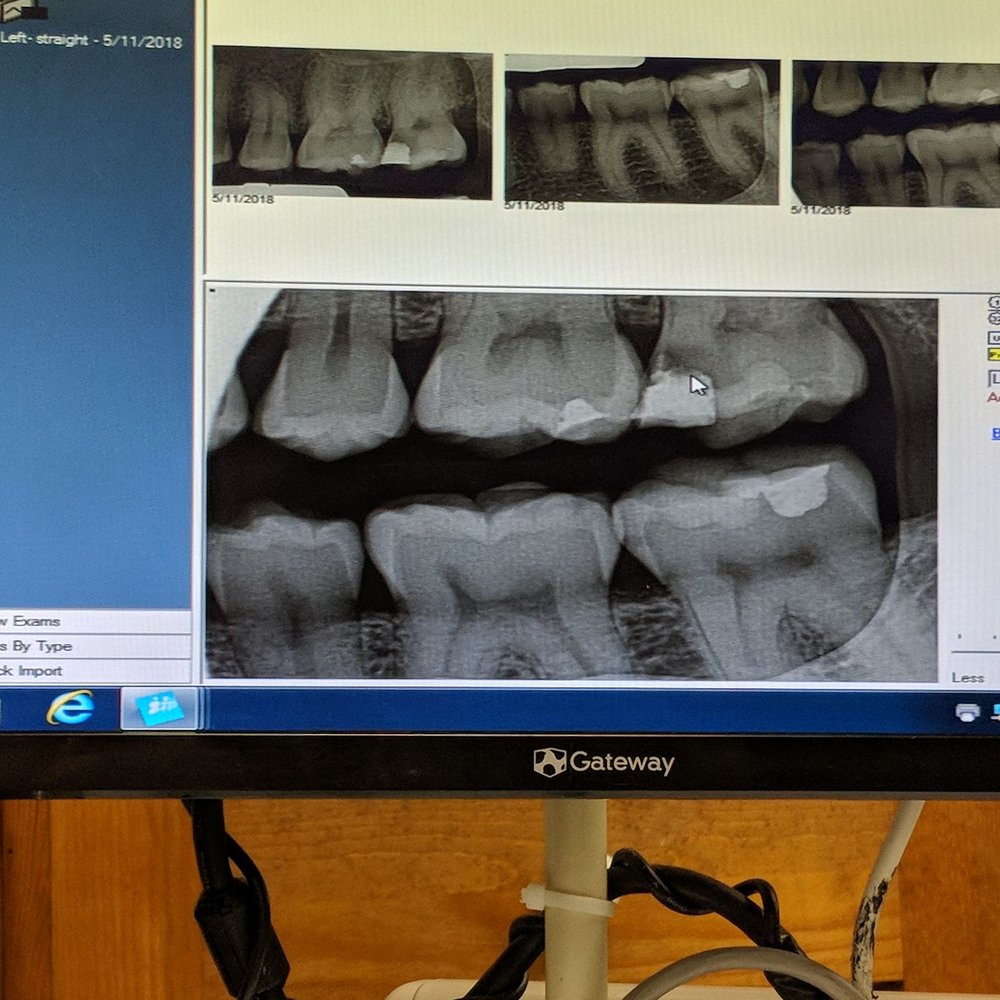 Simokaitis Francis, DDS - X-ray at the new dentist where it's pretty obvious I have an issue! (Bright white & dark area) - General Dentistry Near Me - Saint Louis, Missouri Simokaitis Francis, DDS - X-ray at the new dentist where it's pretty obvious I have an issue! (Bright white & dark area) - General Dentistry Near Me - Saint Louis, Missouri