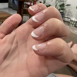 Peeling 5 days later- gel Peeling 5 days later- gel